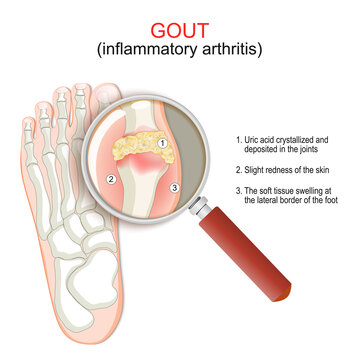 Gout. Close-up of joint with inflammatory arthritis.
