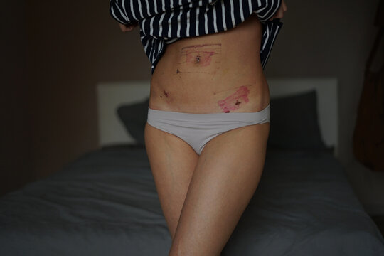 consequences after peritonitis