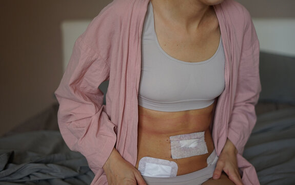 a woman shows off her stomach after surgery