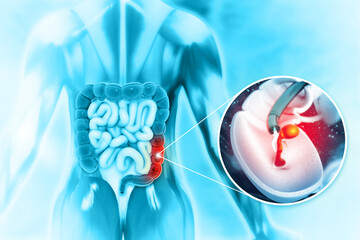 colon cancer. colonoscope in the colon. polyp removal. 3d illustration - obrazy, fototapety, plakaty