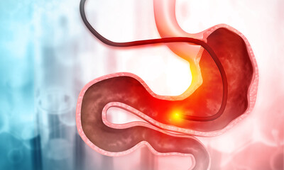 Stomach cancer, stomach Endoscopy. 3d illustration