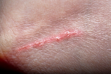Nearly healed scar on the arm. Close-up of leather with a scratch. Photo in soft focus at high magnification.