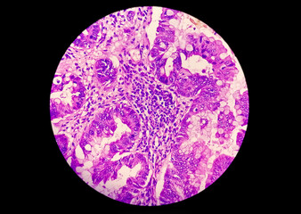 Photomicrograph showing adenocarcinoma. cancer, oncology, histology. 100x