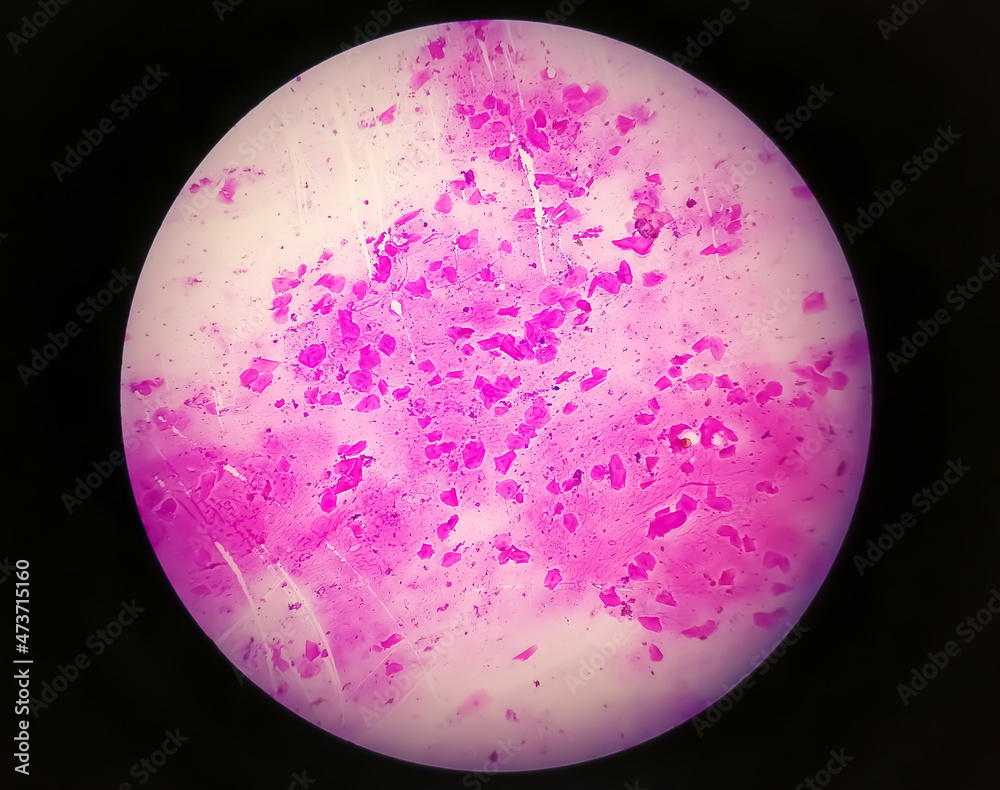 Wall mural high vaginal swab (hvs) gram stain microscopic 10x show few pus cells and epithelial cells. gram pos