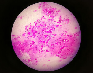 High Vaginal Swab (HVS) gram stain microscopic 10x show few pus cells and epithelial cells. Gram...