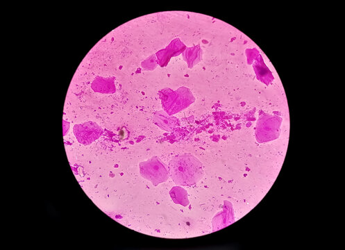 High Vaginal Swab (HVS) Gram Stain Microscopic 40x Show Few Pus Cells And Epithelial Cells. Gram Positive Diplococci And Gram Negative Rods Shape Bacteria.