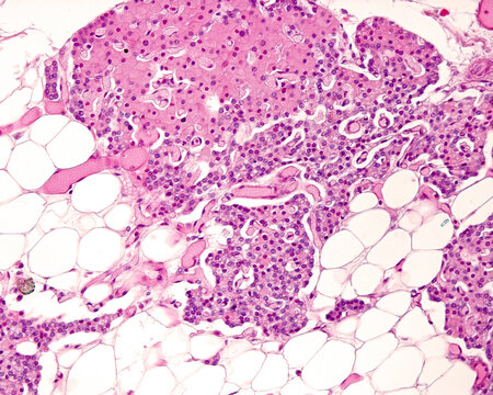 Adult parathyroid gland. Nodule of oxyphilic cells  (top) and chief cells (bottom)