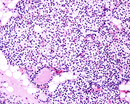Child parathyroid gland parenchyma  with chief cells. No oxyphilic cells.