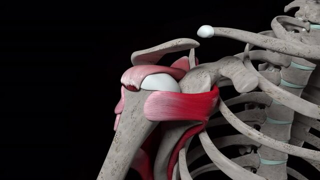 Shoulder Injury with Large U Tear of the Rotator Cuff