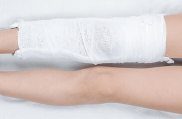 Broken leg cast. Knee injury in a child.
