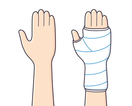 Broken arm, bone fracture, orthopedic plaster cast isolated, trauma rehabilitation cartoon vector illustration.