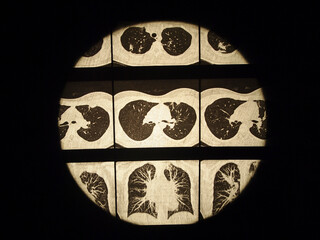 View of the results of computed tomography of the lungs.