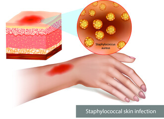 Staphylococcal skin infection or Staph infection. Infestation with secondary or superimposed bacterial infection Skin cellulitis.  - obrazy, fototapety, plakaty