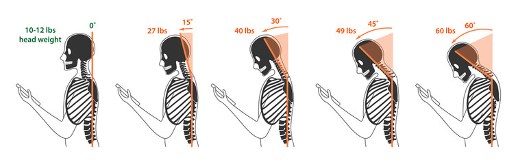 Computer neck syndrome, tech neck, text neck. Changes in pressure on the cervical spine with different head positions. Flat vector illustration is isolated on white background - obrazy, fototapety, plakaty