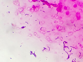 Gram positive cocci in cluster of Staphylococcus spp. under 100X microscope.