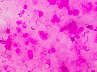 Gram positive cocci in cluster of Staphylococcus spp. under 100X microscope.