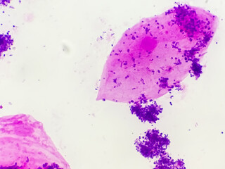 Prostatic Smear gram stained microscopic 100x show Epithelial cells and Neisseria gonorrhoeae, also known as gonococci bacteria. Which is causes for Gonorrhea - obrazy, fototapety, plakaty