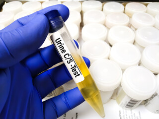 Urine specimen for culture and sensitivity test