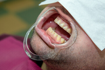 open mouth for dental treatment