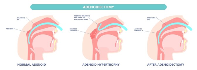 Adenoidectomy. Throat back voice box larynx vocal cord pain airway endoscopic sinus surgery ear nose sleep apnea oral airway septal obstructive biopsy tumor Pharynx flexible fibre optic polypectomy