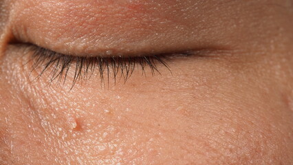 Obraz premium Wart on face. Macro shot of wart near eye. Papilloma on skin around eye nose and neck. Close up of birthmark Papilla or mole on skin. small hard. benign growth on the skin. caused by virus. skincare.