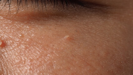 Fototapeta premium Wart on face. Macro shot of wart near eye. Papilloma on skin around eye nose and neck. Close up of birthmark Papilla or mole on skin. small hard. benign growth on the skin. caused by virus. skincare.