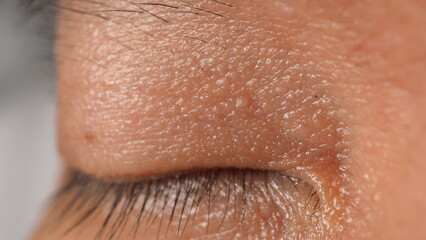 Fototapeta premium Wart on face. Macro shot of wart near eye. Papilloma on skin around eye nose and neck. Close up of birthmark Papilla or mole on skin. small hard. benign growth on the skin. caused by virus. skincare.