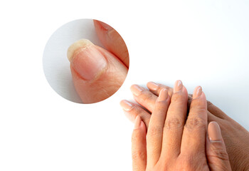 Zoom in image of brittle weak dry cracked pitted woman's fingernails surface and prone to breakage caused by harsh ingredients in nail polish formulas on white background. - obrazy, fototapety, plakaty