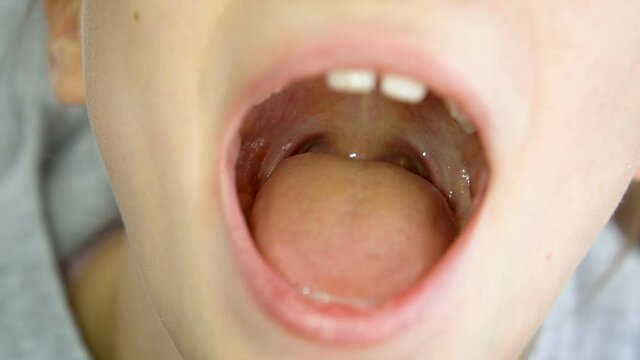 Wide open mouth with a tongue stuck out, view of the uvula and the soft palate of little girl, pediatric dentistry