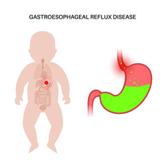 GERD in infant body