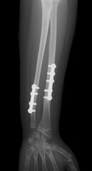 x ray of  broken hand ,internal fixation plate and screw on ulna and radius 