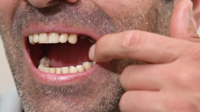 Experiencing tooth loss. Mouth close-up tooth loss.
