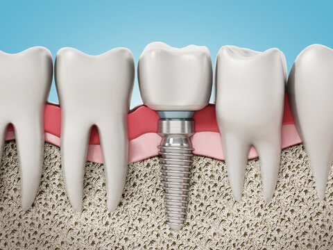 3D rendering of tooth implant showing jaw gum and bone layers. 3D illustration