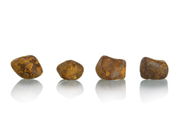 Cholelithiasis (gallstones) with gallbladder disease after cholecystectomy isolated on white