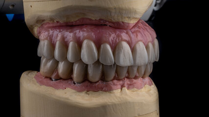 Dental implants and dentures in close-up Siemke on a black background
