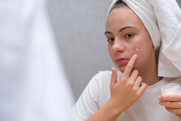 teenage girl . Acne. Care for problem skin