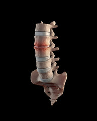 Lumbar spine with stenosis condition on black background