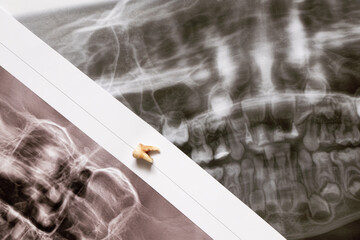 A panoramic image shows several embedded and impacted teeth as on the upper one, the extracted tooth lies in the images, Beta dentistry © Виктория Котлярчук