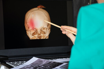 3d computed tomography of the brain with a fracture of the frontal part of the skull on laptop...
