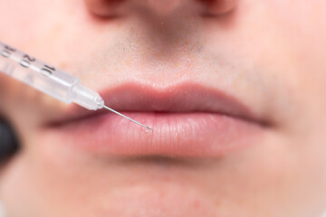 Close up of a drop of a drug falling from a syringe needle on the lips of a male patient of a cosmetology office. Rejuvenation procedure, injections of hyaluronic acid to moisturize the lips