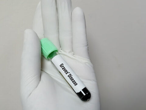 Blood sample tube for Graves' disease test at medical laboratory. Autoimmune disease that affects the thyroid gland. The gland produces too much thyroid hormone