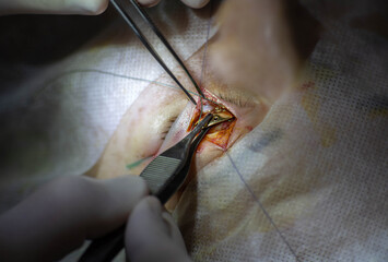 unique surgical operation for neuritis of the facial nerve, implantation of a gold implant in the...