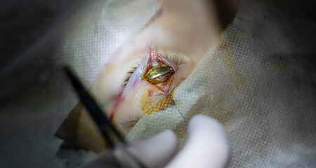 unique surgical operation for neuritis of the facial nerve, implantation of a gold implant in the...