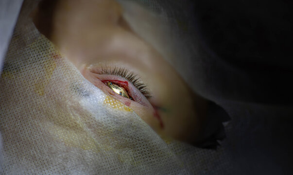 unique surgical operation for neuritis of the facial nerve, implantation of a gold implant in the eyelids, before the eye does not close. gold eyelid weights surgery
