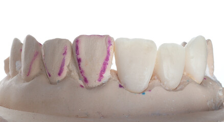 anterior teeth carved in wax and plaster