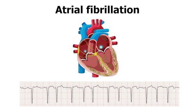 heart arrhythmia atrial fibrillation with ecg