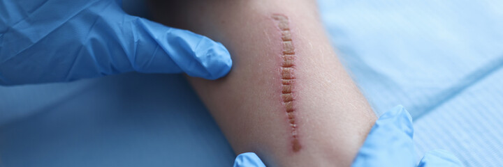 Doctor in rubber protective gloves examining patient scar in clinic closeup - obrazy, fototapety, plakaty