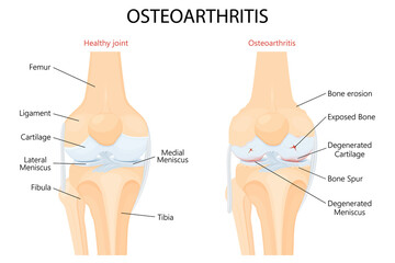 Knee Osteoarthritis and normal joint detailed anatomy. Osteoarthritis. Arthritis or pain within a joint. degenerative joint disease. Cartilage becomes worn. Vector flat design