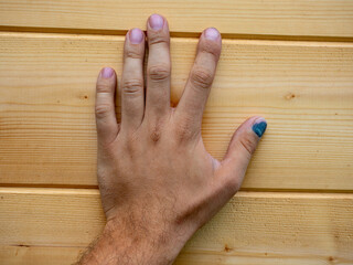 Close-up of a thumped thumb. Blurred wooden background in the background. Injury at work, bruise,...