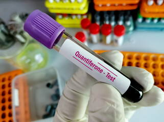 Test tube with blood sample for Quantiferon test, diagnosis for mycobacterium tuberculosis infection